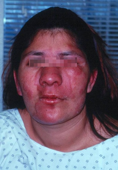 fotos de lepra (8)_thumb[1].jpg